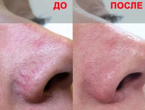 удаление сосудистой сеточки лазером