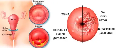 папілома на статевій губі