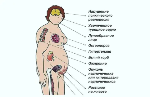 симптоми синдрому Кушинга