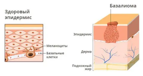 базалиома кожи