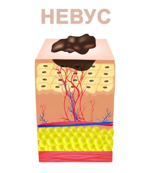 невус