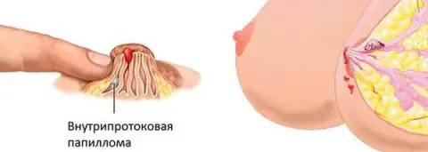папилломы на сосках при беременности