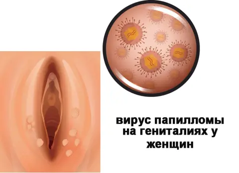 папиллома на половой губе