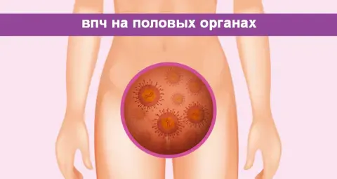 впч на половых органах