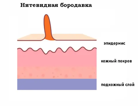 нитевидная бородавка