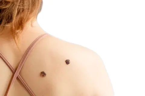 диспластический невус