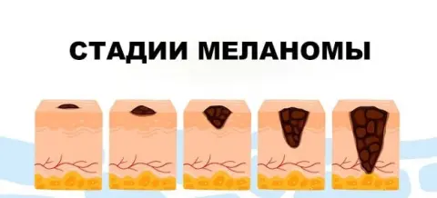 стадии меланомы