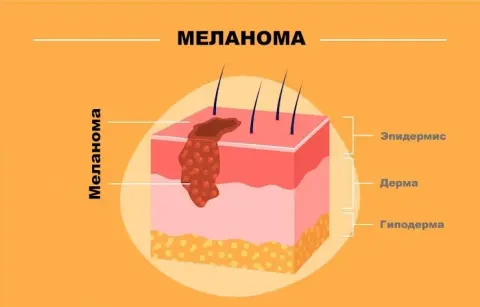 развитие меланомы