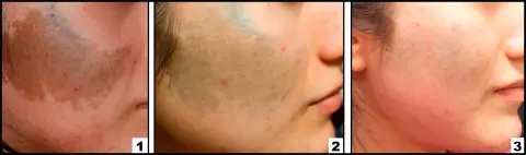 лечение невуса Ота