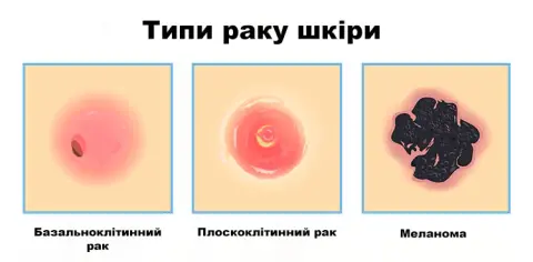 немеланомні пухлини шкіри