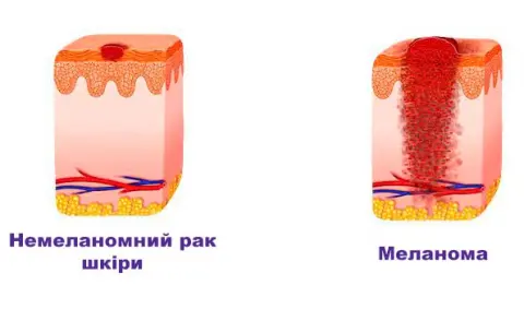 немеланомний рак