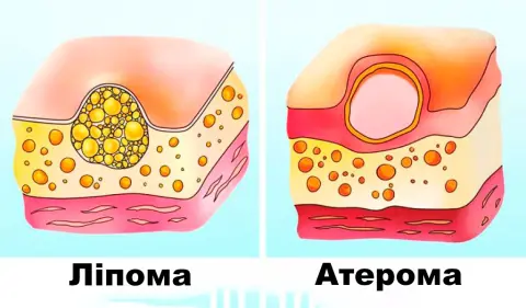 ліпома та атерома