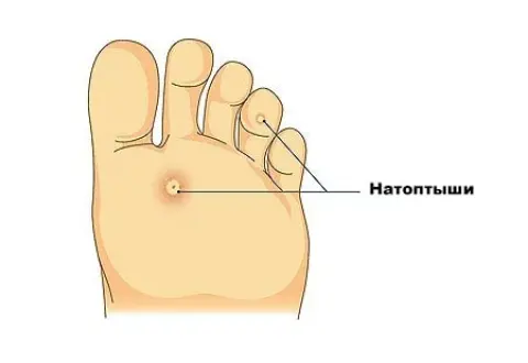 натоптыши