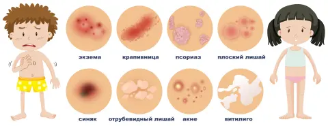 виды пятен на коже у ребенка