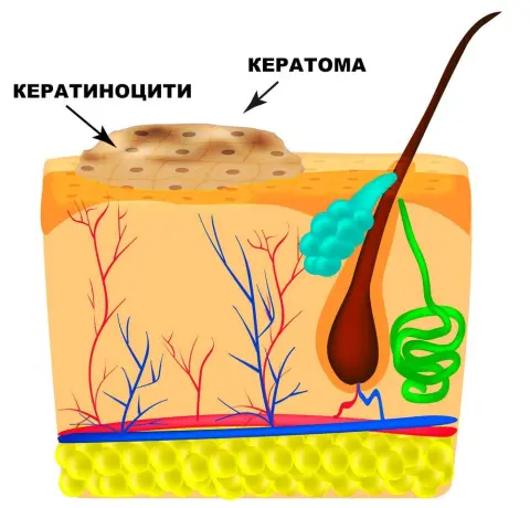 Кератома