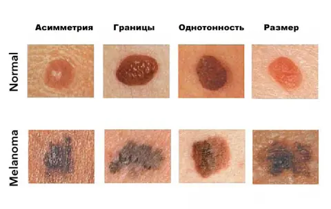 Симптомы меланомы кожи