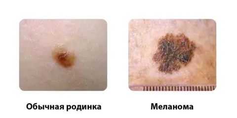 Меланома