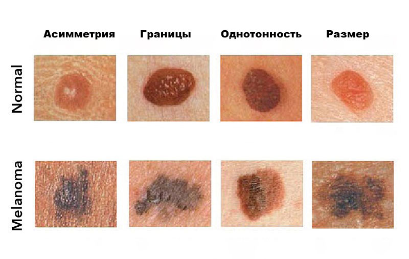 Симптомы меланомы кожи